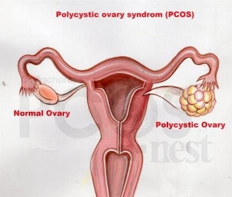 What is PCOS